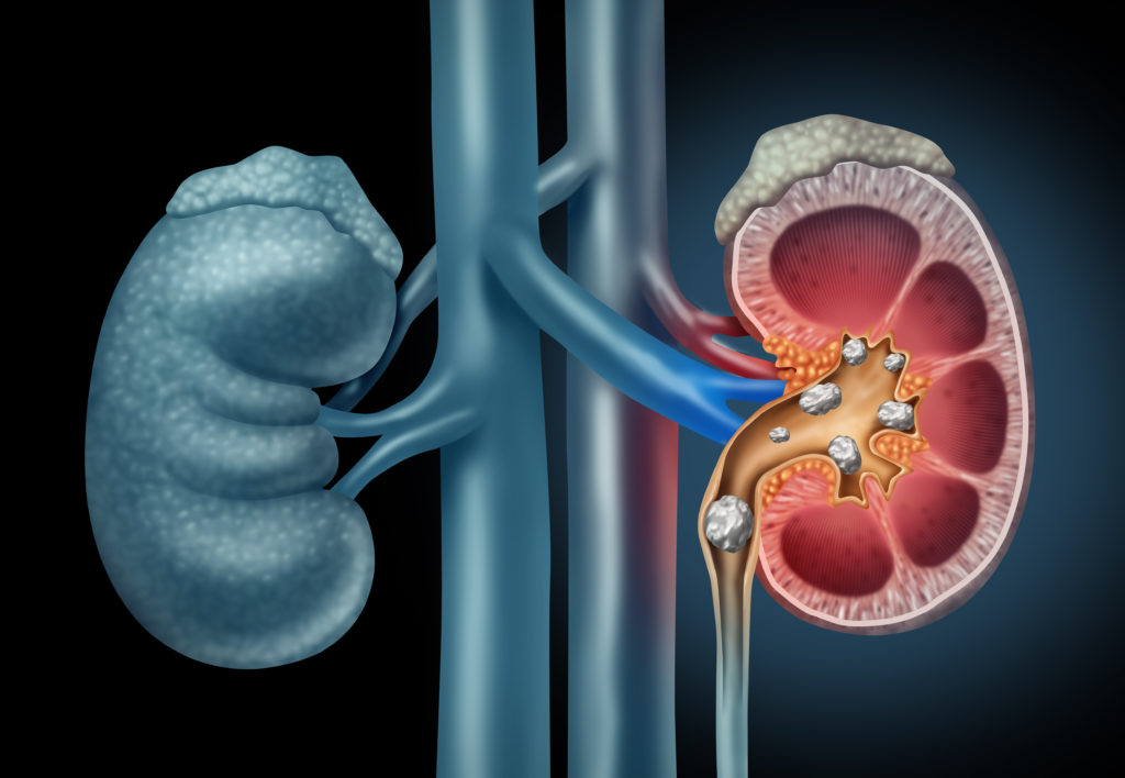 what-other-methods-are-there-for-removing-kidney-stones?